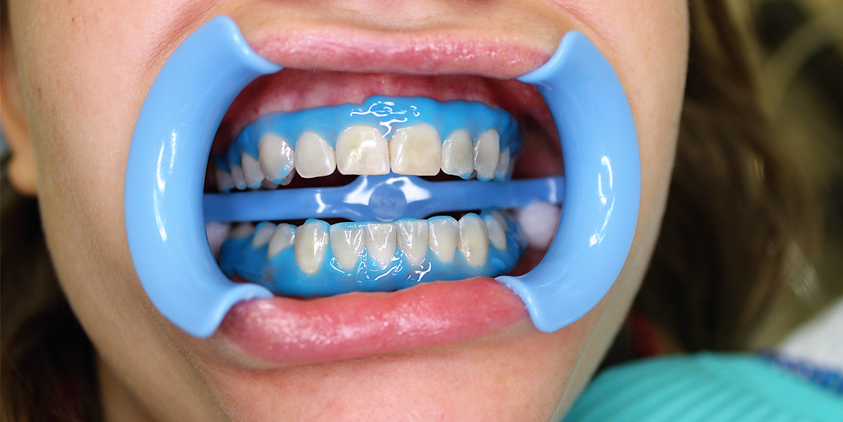 Himicheskoe-otbelivanie-zubov